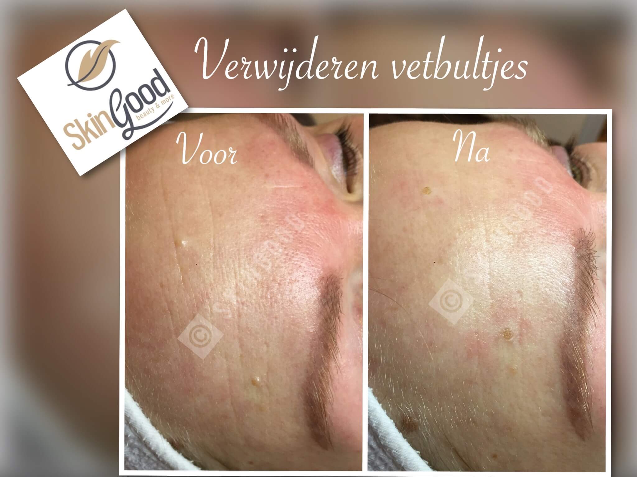 SkinGood Huidoneffenheden